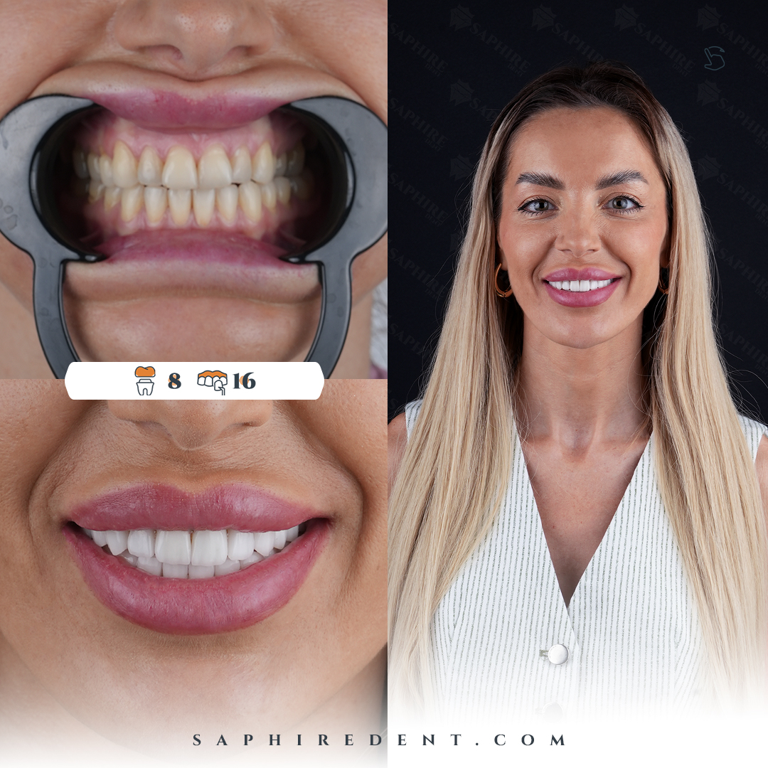 Hollywood Smile